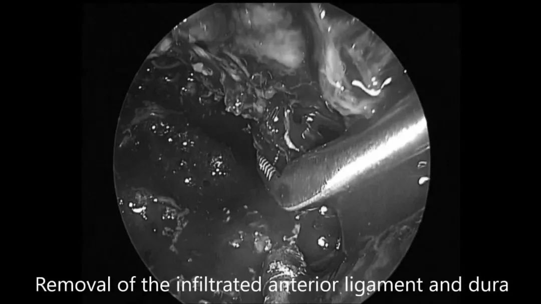 “筷子技术”神经内镜切除浸润前韧带和硬脑膜的脊索瘤