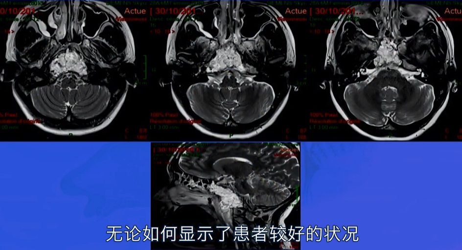 不开颅从鼻孔1cm切口竟就可以取出较大脑瘤