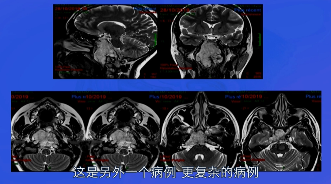 不开颅就把大手术做了，从鼻子切脑子里的肿瘤